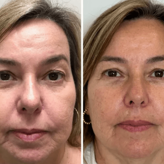 Mascarilla Coreana de Colágeno Rejuvenecedora Peel-Off – Collagen Fit™